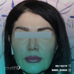 Example of gel and filler injection 03