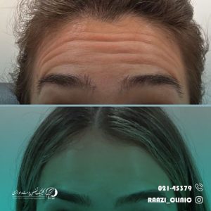 Forehead botox injection sample 01