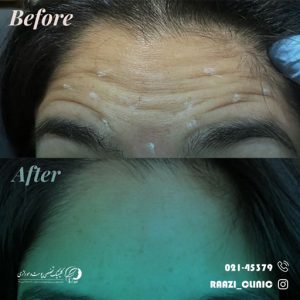 Forehead botox injection sample 02