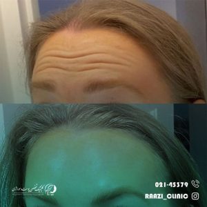 Forehead botox injection sample 04