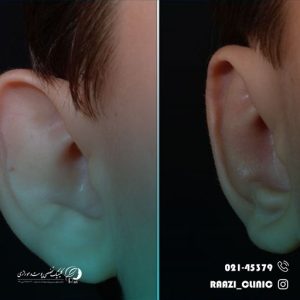 Ear otoplasty number 15