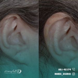 Ear otoplasty number 16